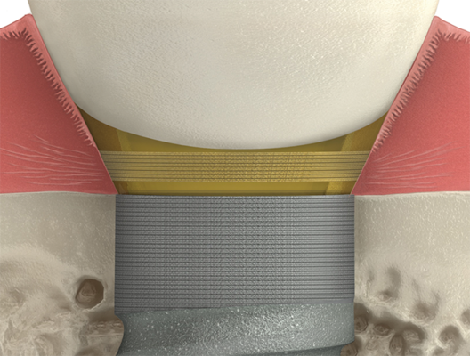 BioHorizons Tapered Internal Implant detailed view BioHorizons Tapered Internal Implant detailed view