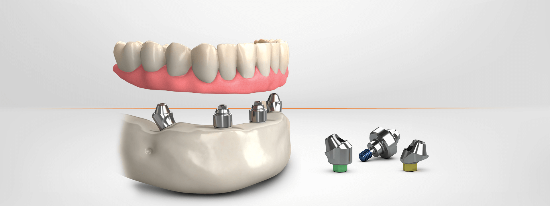 BioHorizons TeethXpress: immediate load solutions