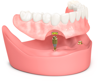 BioHorizons OD Secure Model