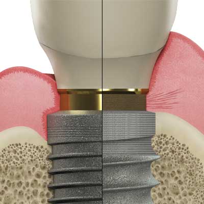 Laser-Lok surface Laser-Lok surface