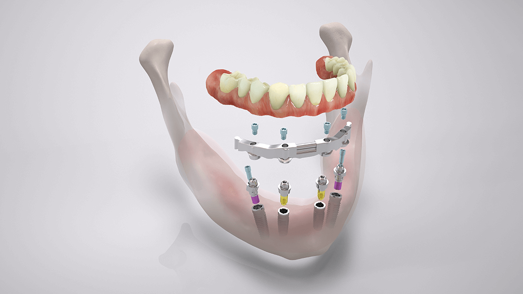 COMFOUR System screw-retained bar